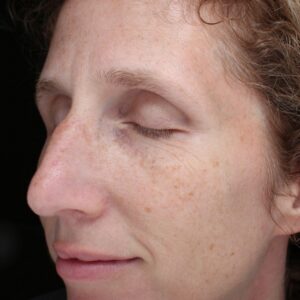 BBL® & BBL® HERO™ Before and After Photo by Coachlight Clinic & Spa in West Des Moines Iowa