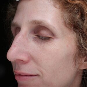BBL® & BBL® HERO™ Before and After Photo by Coachlight Clinic & Spa in West Des Moines Iowa