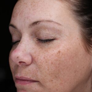 BBL® & BBL® HERO™ Before and After Photo by Coachlight Clinic & Spa in West Des Moines Iowa