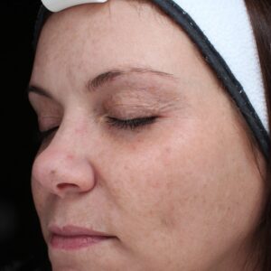BBL® & BBL® HERO™ Before and After Photo by Coachlight Clinic & Spa in West Des Moines Iowa