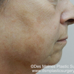 BBL® & BBL® HERO™ Before and After Photo by Coachlight Clinic & Spa in West Des Moines Iowa