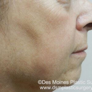BBL® & BBL® HERO™ Before and After Photo by Coachlight Clinic & Spa in West Des Moines Iowa