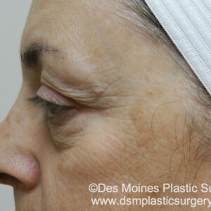 BBL® & BBL® HERO™ Before and After Photo by Coachlight Clinic & Spa in West Des Moines Iowa