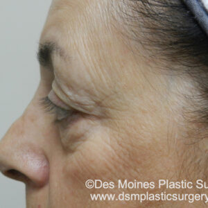 BBL® & BBL® HERO™ Before and After Photo by Coachlight Clinic & Spa in West Des Moines Iowa