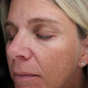 BBL® & BBL® HERO™ Before and After Photo by Coachlight Clinic & Spa in West Des Moines Iowa