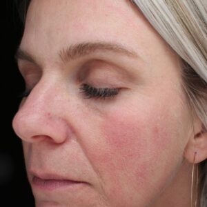 BBL® & BBL® HERO™ Before and After Photo by Coachlight Clinic & Spa in West Des Moines Iowa