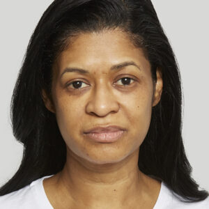 Sculptra Before and After Photo by Coachlight Clinic & Spa in West Des Moines Iowa