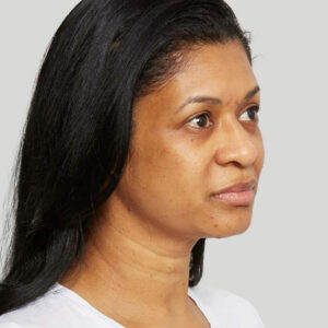 Sculptra Before and After Photo by Coachlight Clinic & Spa in West Des Moines Iowa