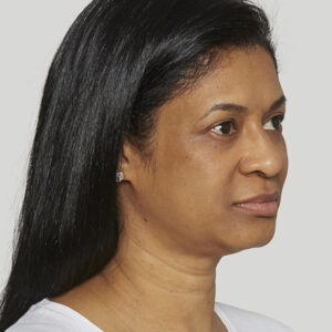 Sculptra Before and After Photo by Coachlight Clinic & Spa in West Des Moines Iowa