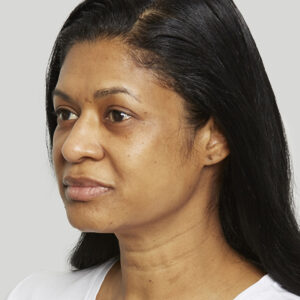 Sculptra Before and After Photo by Coachlight Clinic & Spa in West Des Moines Iowa