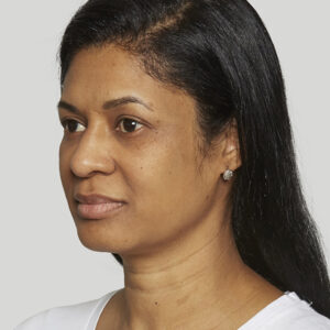 Sculptra Before and After Photo by Coachlight Clinic & Spa in West Des Moines Iowa