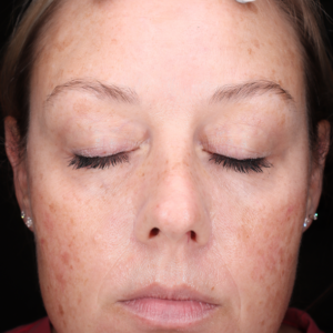 HALO Before and After Photo by Coachlight Clinic & Spa in West Des Moines Iowa