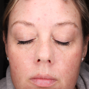 HALO Before and After Photo by Coachlight Clinic & Spa in West Des Moines Iowa