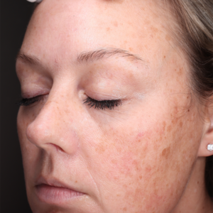 HALO Before and After Photo by Coachlight Clinic & Spa in West Des Moines Iowa