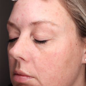 HALO Before and After Photo by Coachlight Clinic & Spa in West Des Moines Iowa
