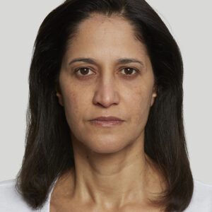Sculptra Before and After Photo by Coachlight Clinic & Spa in West Des Moines Iowa