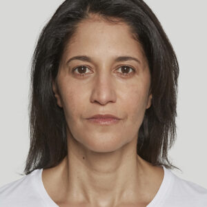 Sculptra Before and After Photo by Coachlight Clinic & Spa in West Des Moines Iowa