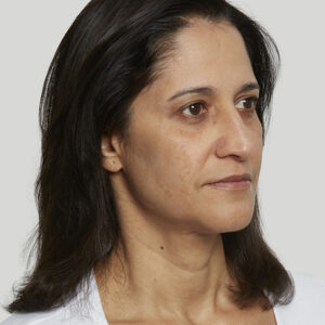 Sculptra Before and After Photo by Coachlight Clinic & Spa in West Des Moines Iowa