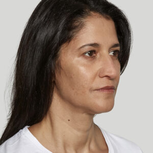 Sculptra Before and After Photo by Coachlight Clinic & Spa in West Des Moines Iowa