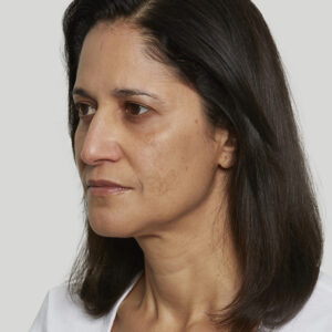 Sculptra Before and After Photo by Coachlight Clinic & Spa in West Des Moines Iowa