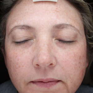 BBL® & BBL® HERO™ Before and After Photo by Coachlight Clinic & Spa in West Des Moines Iowa