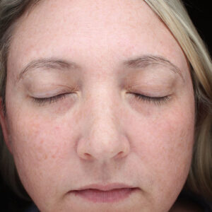BBL® & BBL® HERO™ Before and After Photo by Coachlight Clinic & Spa in West Des Moines Iowa