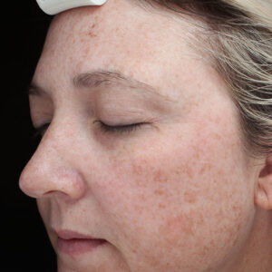 MOXI Before and After Photo by Coachlight Clinic & Spa in West Des Moines Iowa