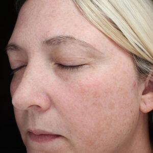 BBL® & BBL® HERO™ Before and After Photo by Coachlight Clinic & Spa in West Des Moines Iowa