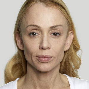 Sculptra Before and After Photo by Coachlight Clinic & Spa in West Des Moines Iowa