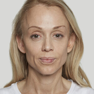 Sculptra Before and After Photo by Coachlight Clinic & Spa in West Des Moines Iowa