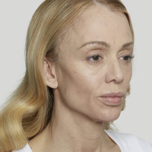 Sculptra Before and After Photo by Coachlight Clinic & Spa in West Des Moines Iowa
