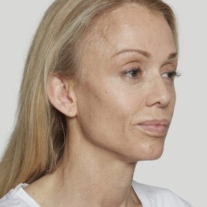 Sculptra Before and After Photo by Coachlight Clinic & Spa in West Des Moines Iowa
