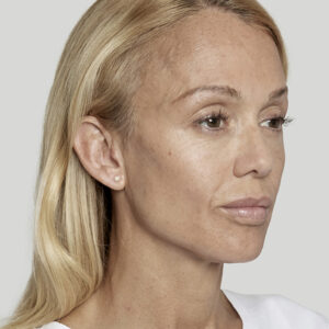 Sculptra Before and After Photo by Coachlight Clinic & Spa in West Des Moines Iowa
