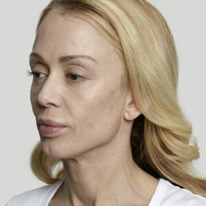 Sculptra Before and After Photo by Coachlight Clinic & Spa in West Des Moines Iowa