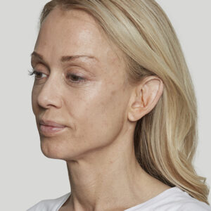Sculptra Before and After Photo by Coachlight Clinic & Spa in West Des Moines Iowa
