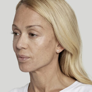 Sculptra Before and After Photo by Coachlight Clinic & Spa in West Des Moines Iowa