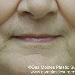 Laser Resurfacing Before and After Photo by Coachlight Clinic & Spa in West Des Moines Iowa