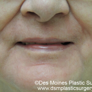 Laser Resurfacing Before and After Photo by Coachlight Clinic & Spa in West Des Moines Iowa
