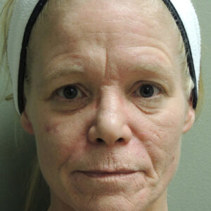 Laser Resurfacing Before and After Photo by Coachlight Clinic & Spa in West Des Moines Iowa