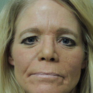 Laser Resurfacing Before and After Photo by Coachlight Clinic & Spa in West Des Moines Iowa