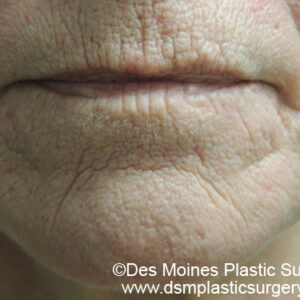 Laser Resurfacing Before and After Photo by Coachlight Clinic & Spa in West Des Moines Iowa