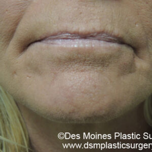 Laser Resurfacing Before and After Photo by Coachlight Clinic & Spa in West Des Moines Iowa