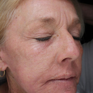 Laser Resurfacing Before and After Photo by Coachlight Clinic & Spa in West Des Moines Iowa