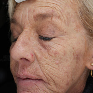 Laser Resurfacing Before and After Photo by Coachlight Clinic & Spa in West Des Moines Iowa