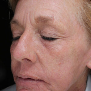 Laser Resurfacing Before and After Photo by Coachlight Clinic & Spa in West Des Moines Iowa