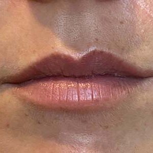 Lip Filler Before and After Photo by Coachlight Clinic & Spa in West Des Moines Iowa