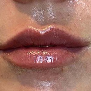 Lip Filler Before and After Photo by Coachlight Clinic & Spa in West Des Moines Iowa