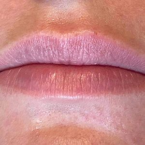 Lip Filler Before and After Photo by Coachlight Clinic & Spa in West Des Moines Iowa