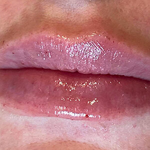 Lip Filler Before and After Photo by Coachlight Clinic & Spa in West Des Moines Iowa
