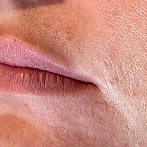 Lip Filler Before and After Photo by Coachlight Clinic & Spa in West Des Moines Iowa